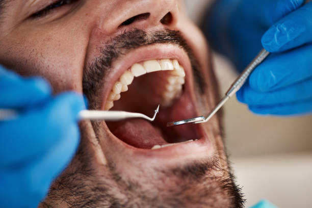 Best Emergency Wisdom Teeth Removal in White Oak, MS
